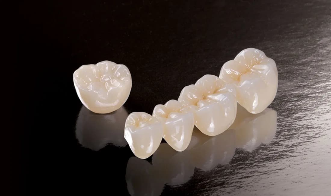 Restorative dental bridge