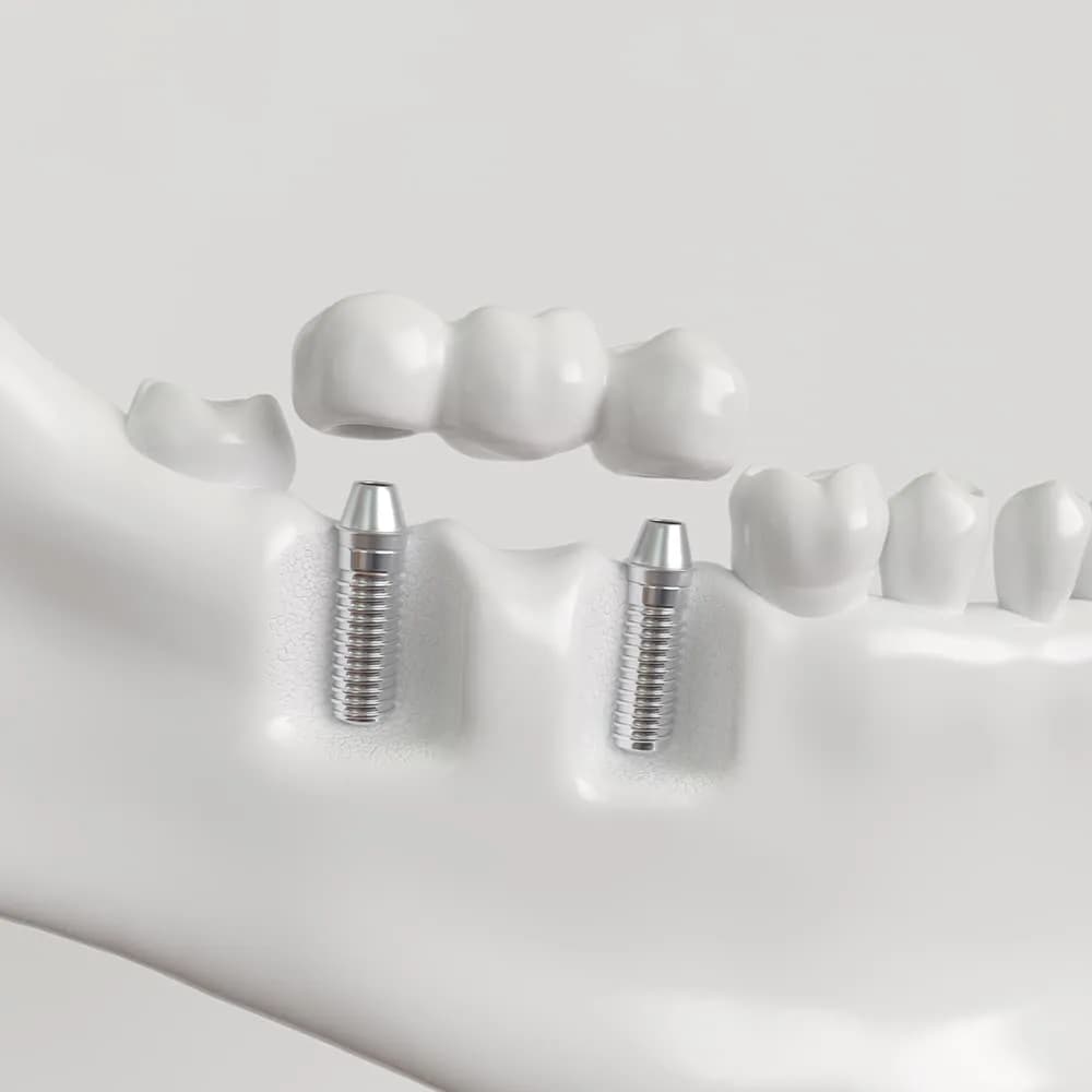 Implant bridge illustration