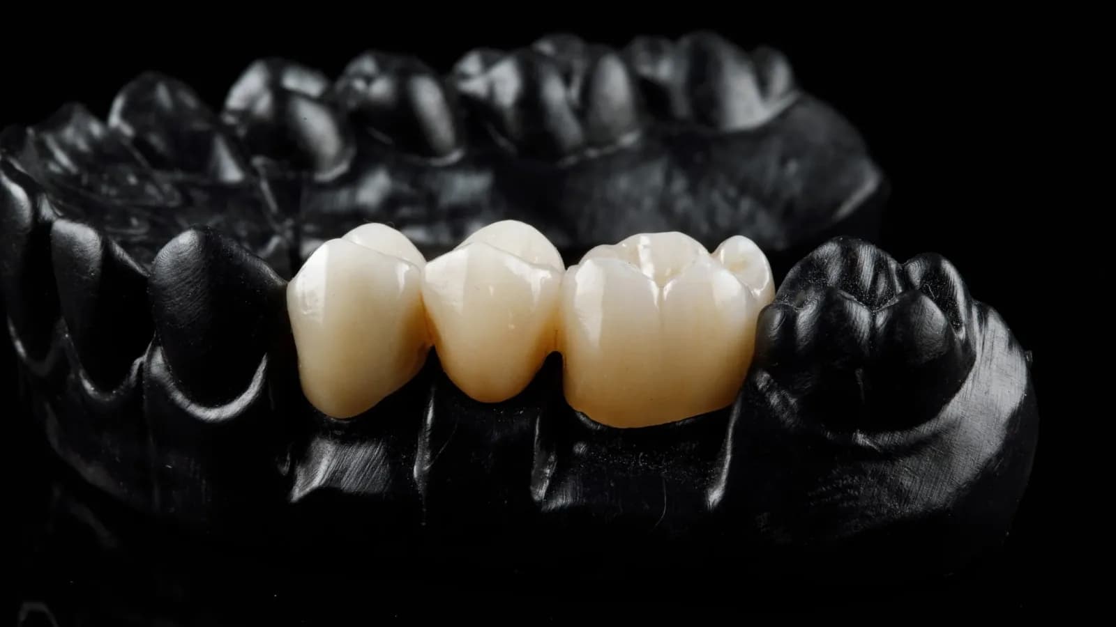 Restorative bridge on model