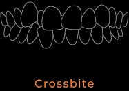Crossbite