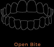 Open Bite