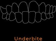 Underbite